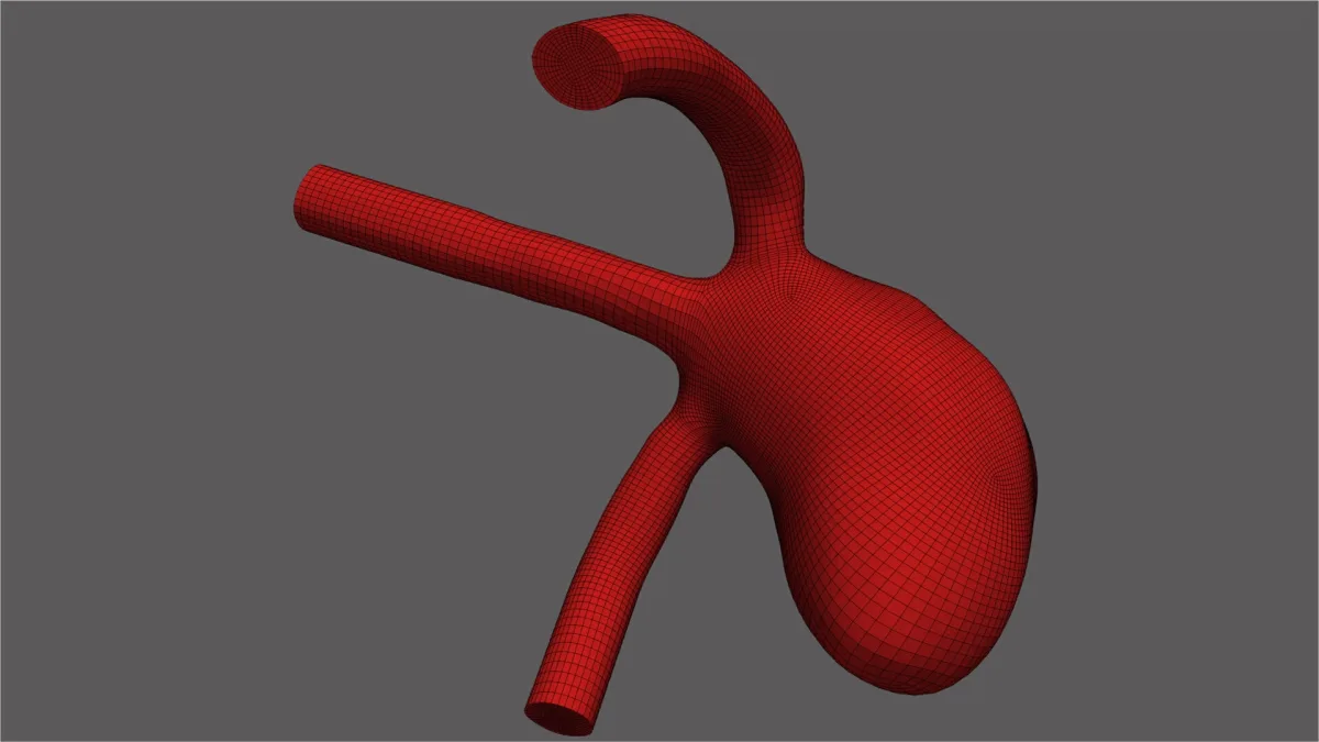 Aneurysm_image 1_high_resolutuion