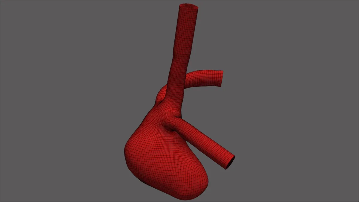Aneurysm_image2_high_res