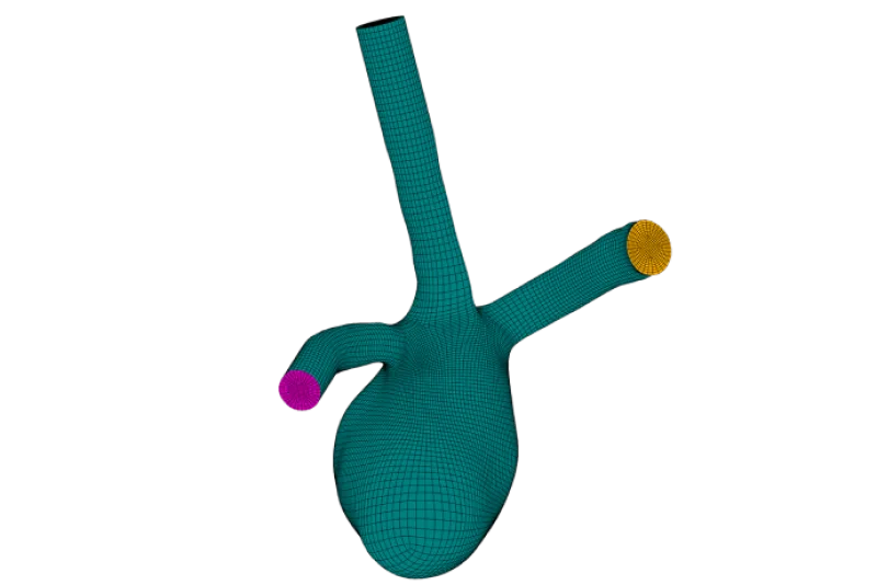 Aneurysm_image