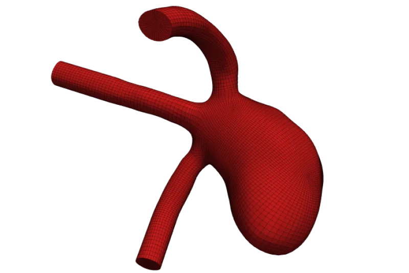 Aneurysm_image 1