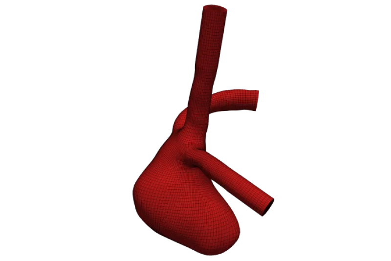 Aneurysm_image2
